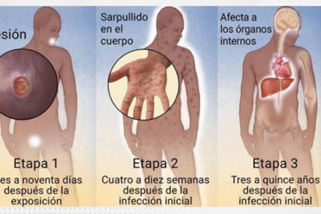 AJUSTES A LA PRUEBA RÁPIDA DE SIFILIS y RPR